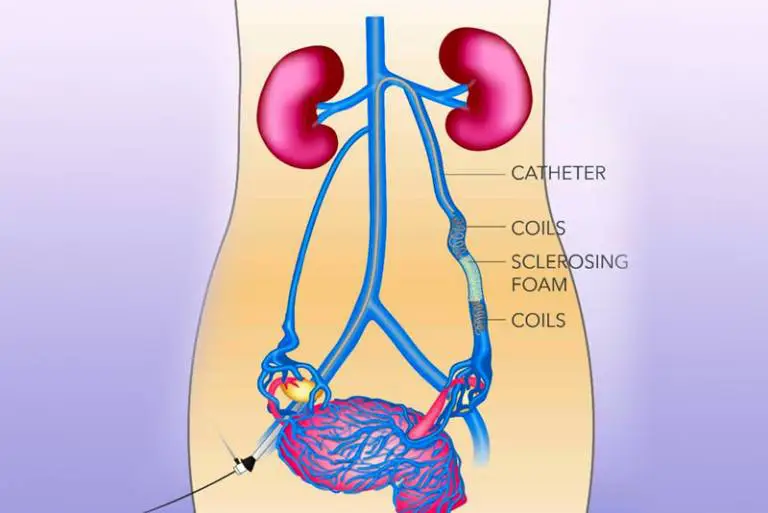 Pelvic congestion syndrome and ovarian cancer: Connection